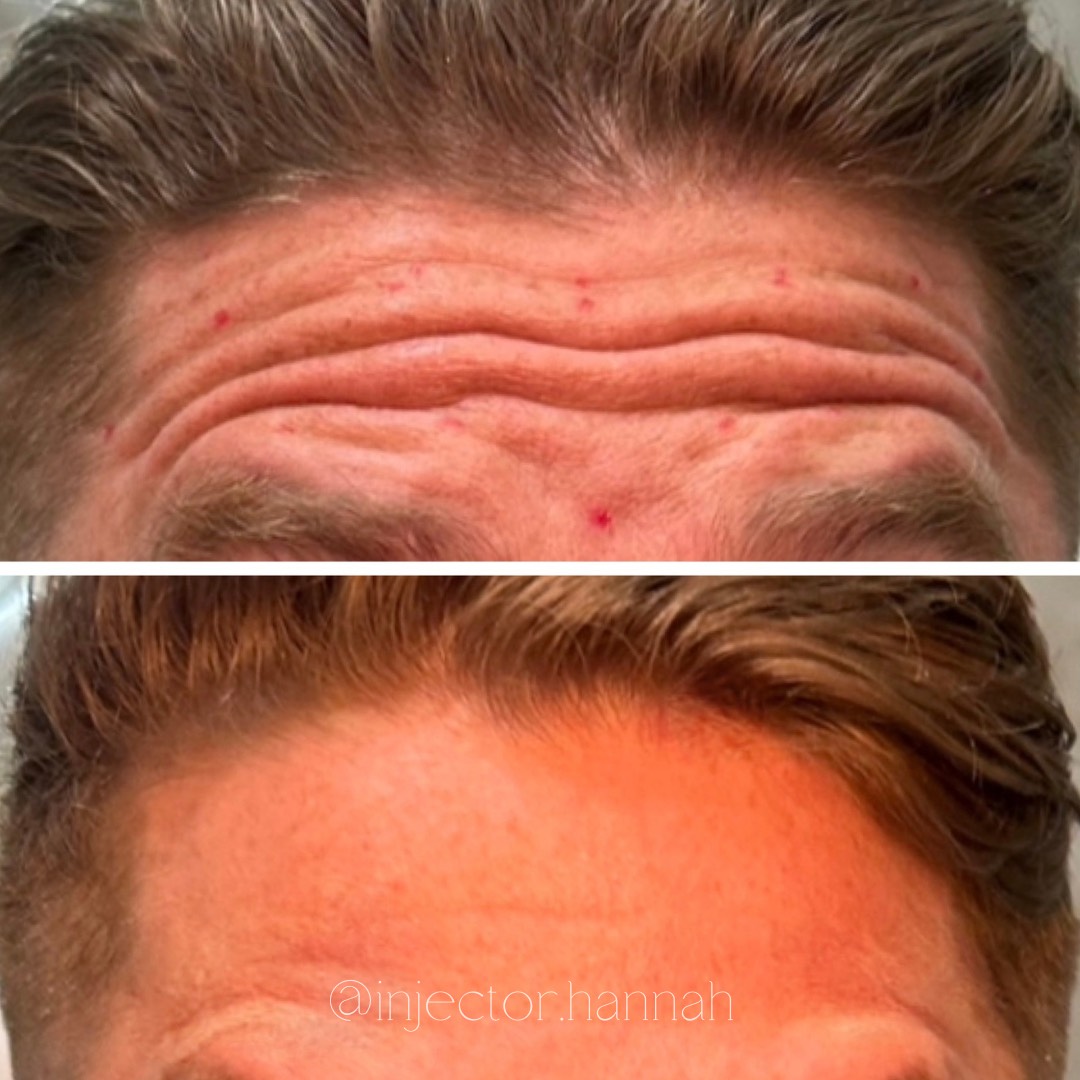 Forehead lines before/after – smoother after 2 weeks